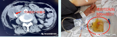 略阳县医院暨中医院首例在CT引导下经皮经肝胆囊造瘘术(PTGD)成功开展