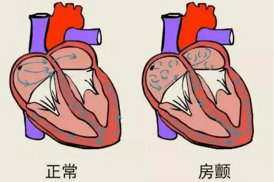 延安市中医医院：“心”病缠身10余载，射频消融术轻松解忧